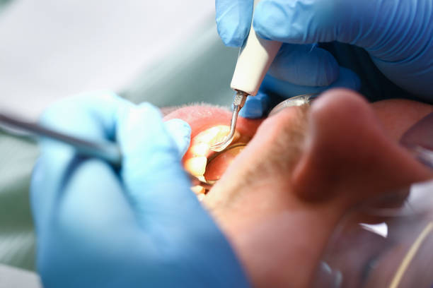 Best Emergency Dental Care for Broken or Chipped Teeth in Lansdale, PA
